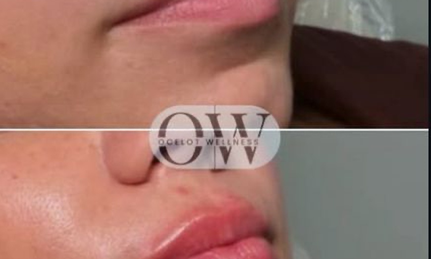 Image 3: Achieve a Refreshed Look with 20, 40, or 60 Units of Botox