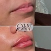Image 3: Achieve a Refreshed Look with 20, 40, or 60 Units of Botox