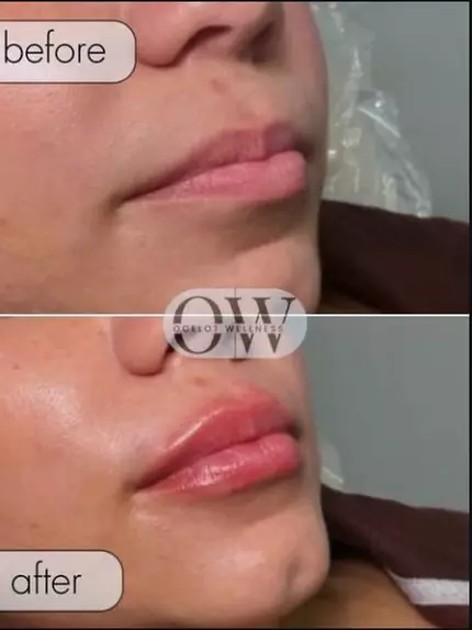 Achieve a Refreshed Look with 20, 40, or 60 Units of Botox