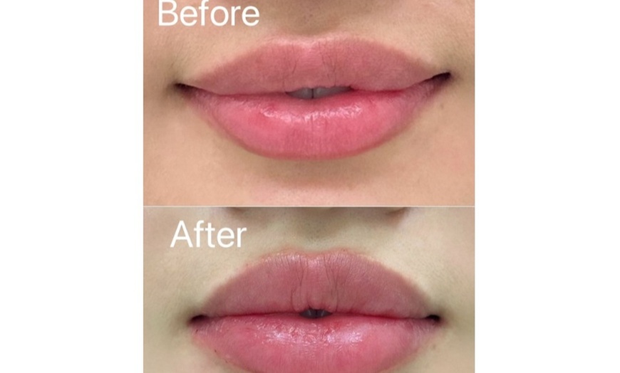 Image 9: One Syringe of Revanesse Versa for Lips or Face at Milan Medical