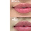 Image 9: One Syringe of Revanesse Versa for Lips or Face at Milan Medical