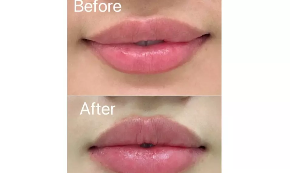 One Syringe of Revanesse Versa for Lips or Face at Milan Medical