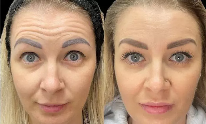 Smooth Away Lines with Botox Lip Flip, 20 or 40 Units of Botox