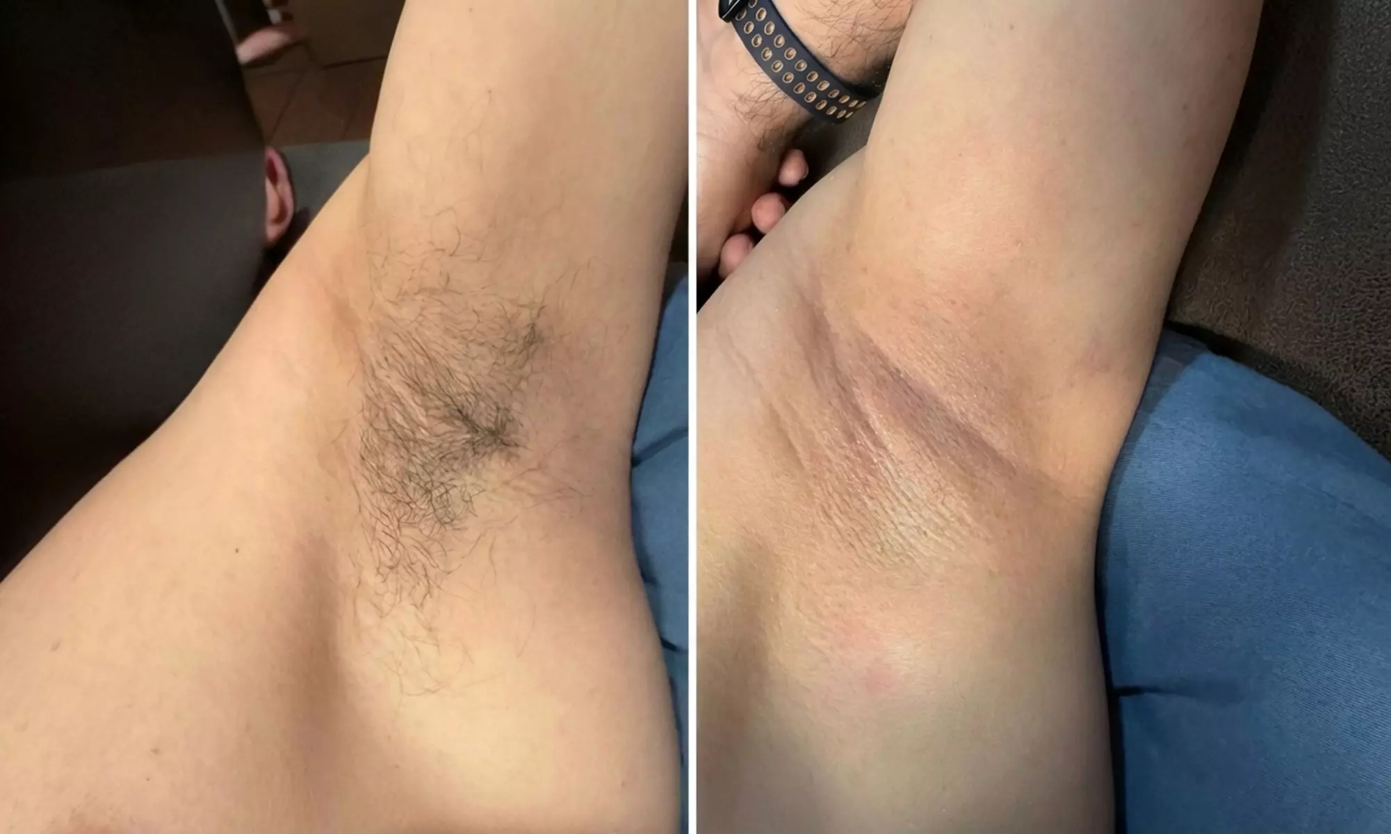 Stoppelvrij door het leven: 3 of 6 keer laserontharingsbehandelingen