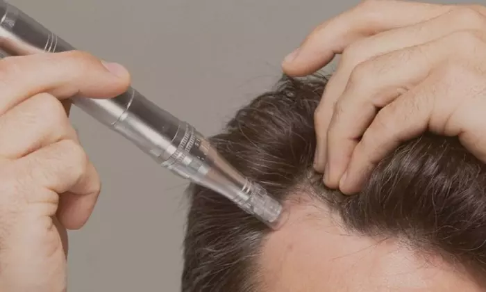 Transform Hair with Three or Six Hair Regrowth Microneedling, LED & Complementary 30-Day Homecare (Up to 60%Off) - Primary Image