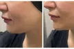Experience HIFU Face Neck or Intimate HIFU Tightening Treatments at 4evayung Beauty (Up To 47% Off) - Image 3