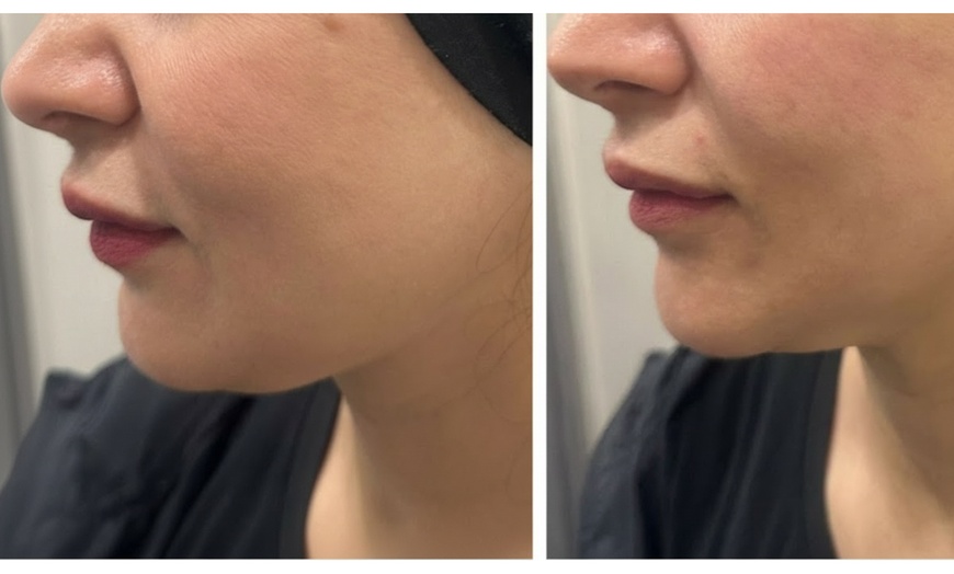 Image 3: Non-Invasive HIFU Face Neck or Intimate HIFU Skin Tightening