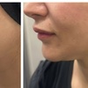Image 3: Non-Invasive HIFU Face Neck or Intimate HIFU Skin Tightening