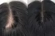 Restore Confidence with Up to 48% Off Scalp Micropigmentation at Rose Beauty Bar - Second Medium