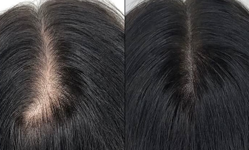 Image 3: Restore Confidence with Scalp Micropigmentation at Rose Beauty Bar