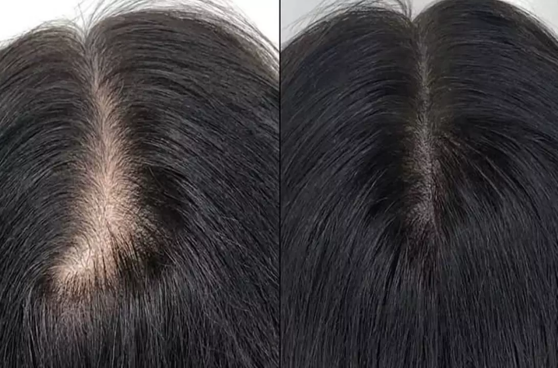Restore Confidence with Up to 48% Off Scalp Micropigmentation at Rose Beauty Bar