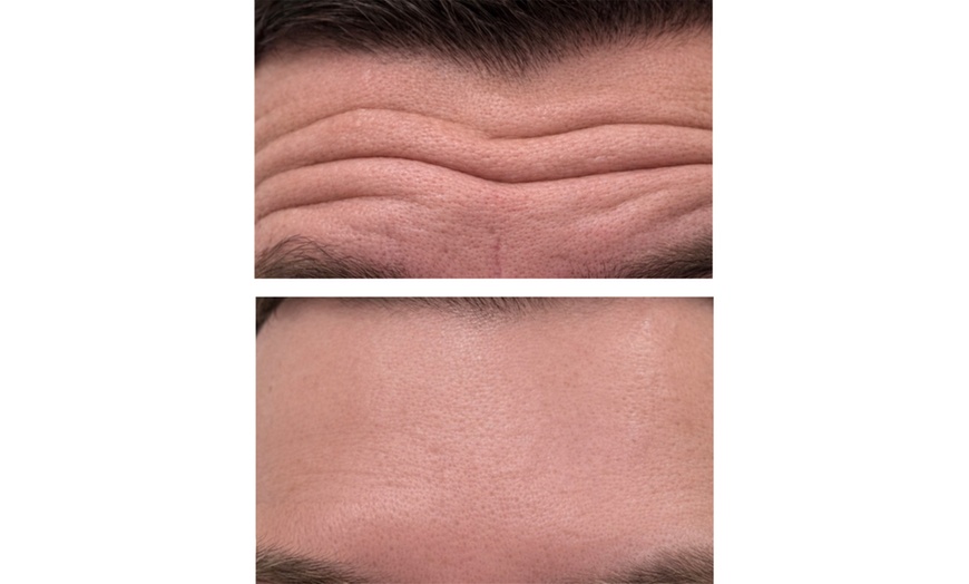 Image 3: 20, 40, or 60 Units of Botox And Filler for Rejuvenating Your Skin 