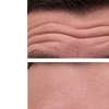 Image 3: 20, 40, or 60 Units of Botox And Filler for Rejuvenating Your Skin 