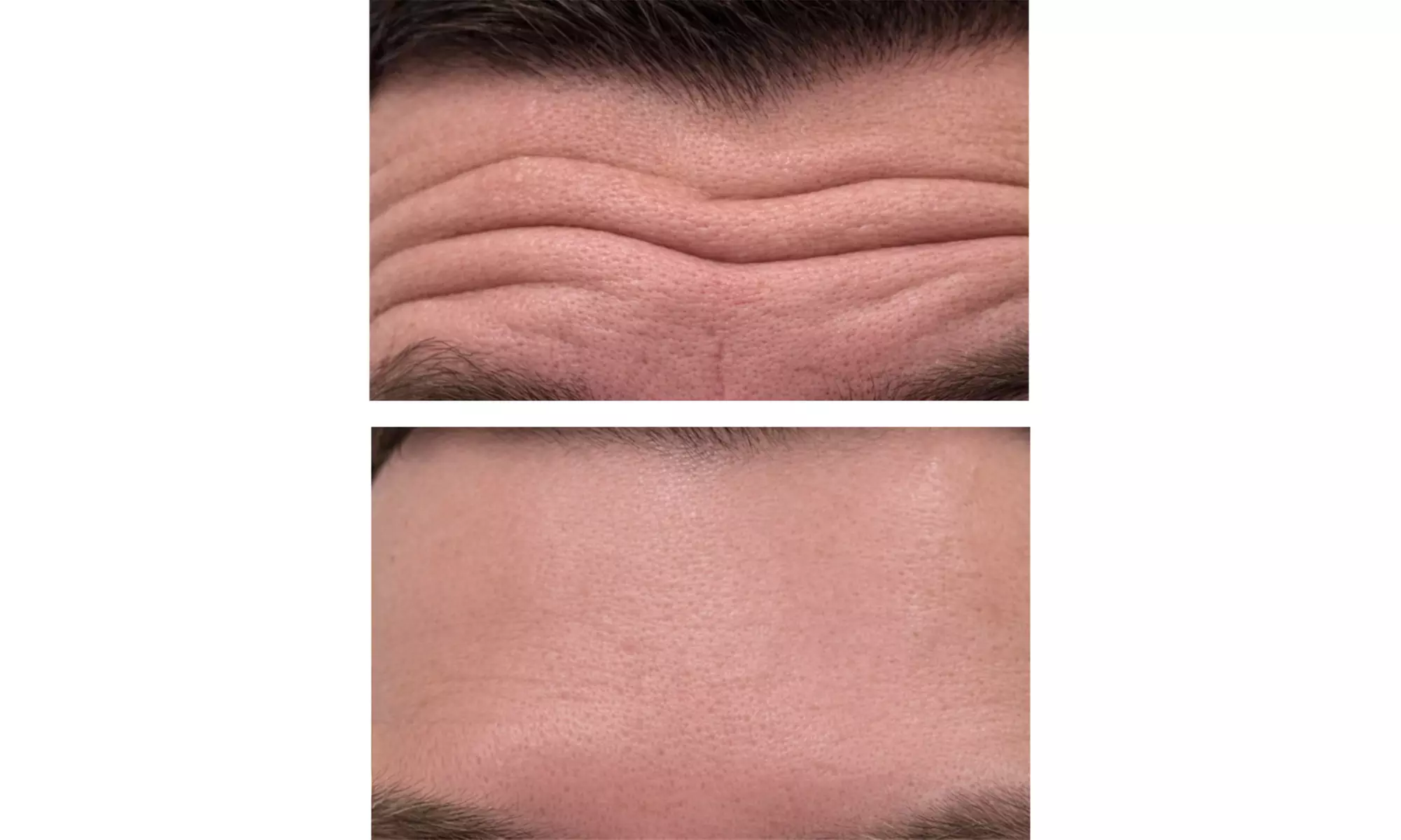 The Ageless Look: Premium Botox® and Filler Bundles At AK Medical Spa
