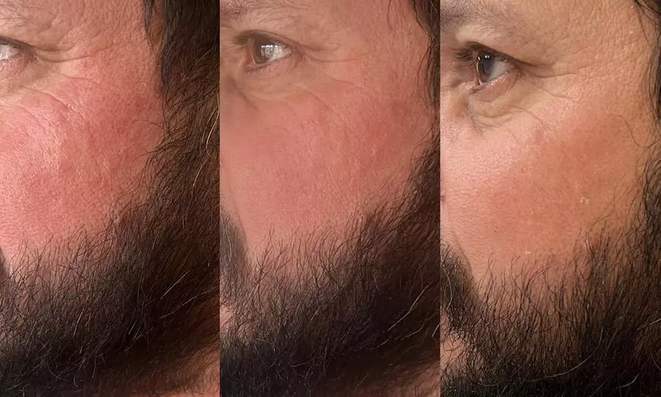 Transform Your Skin w/ One, Three, or Six 60-Min IPL Facial Sessions