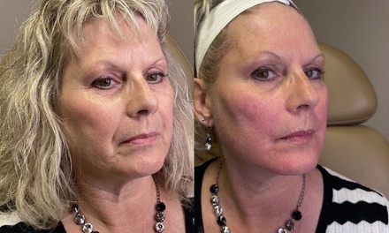 Half Syringe of Radiesse + - Viva La Skin