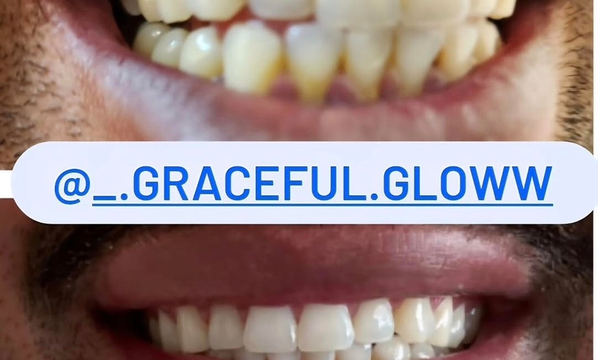 Image 4: Professional Teeth Whitening Treatments