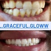 Image 4: Professional Teeth Whitening Treatments
