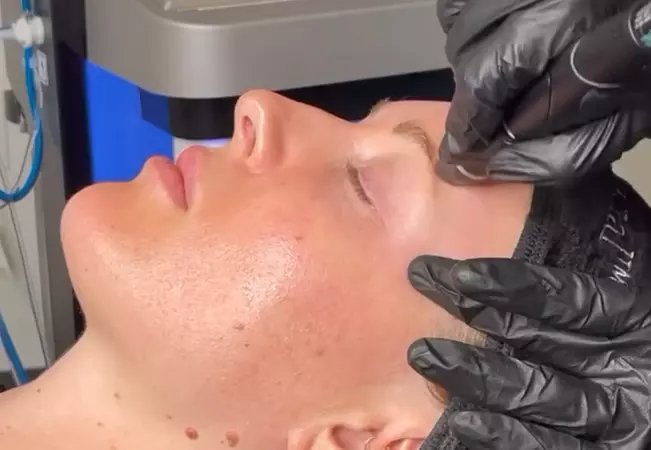 Signature Hydrafacial at Belle Jeunesse!