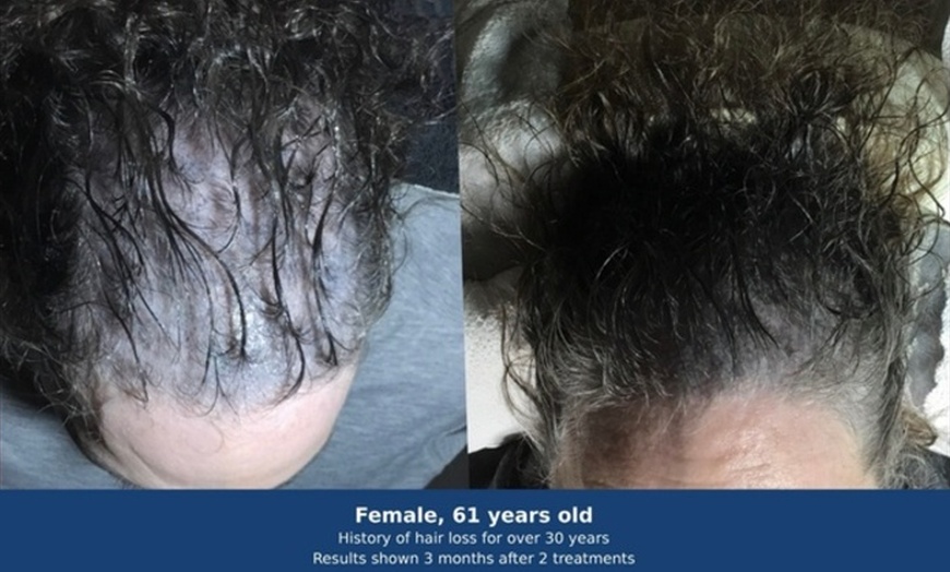 Image 4: Hair Loss Treatments for Two Areas with Ultrasound and Peptides