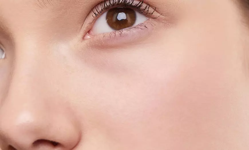 Image 3: Wrinkle Reduction on 2 or 3 Areas (Up to 3 Major & 1 or 2 Minor Areas)