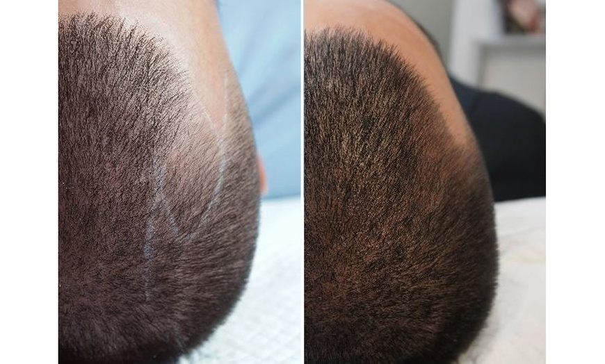Image 3: 1, 2, or 3 Sessions of Scalp Micropigmentation up to 1.5 Hours