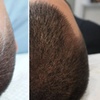 Image 3: 1, 2, or 3 Sessions of Scalp Micropigmentation up to 1.5 Hours