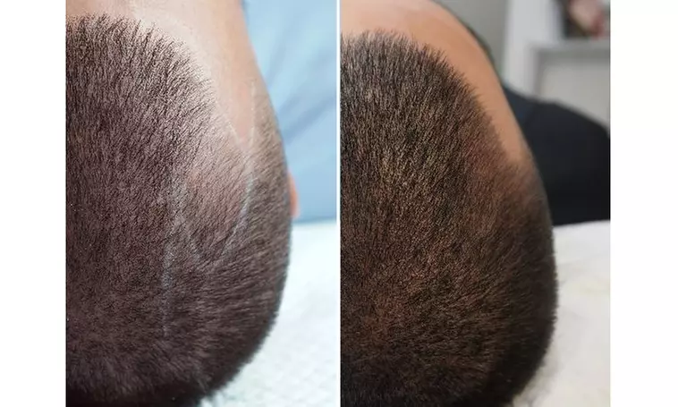 1, 2, or 3 Sessions of Scalp Micropigmentation up to 1.5 Hours