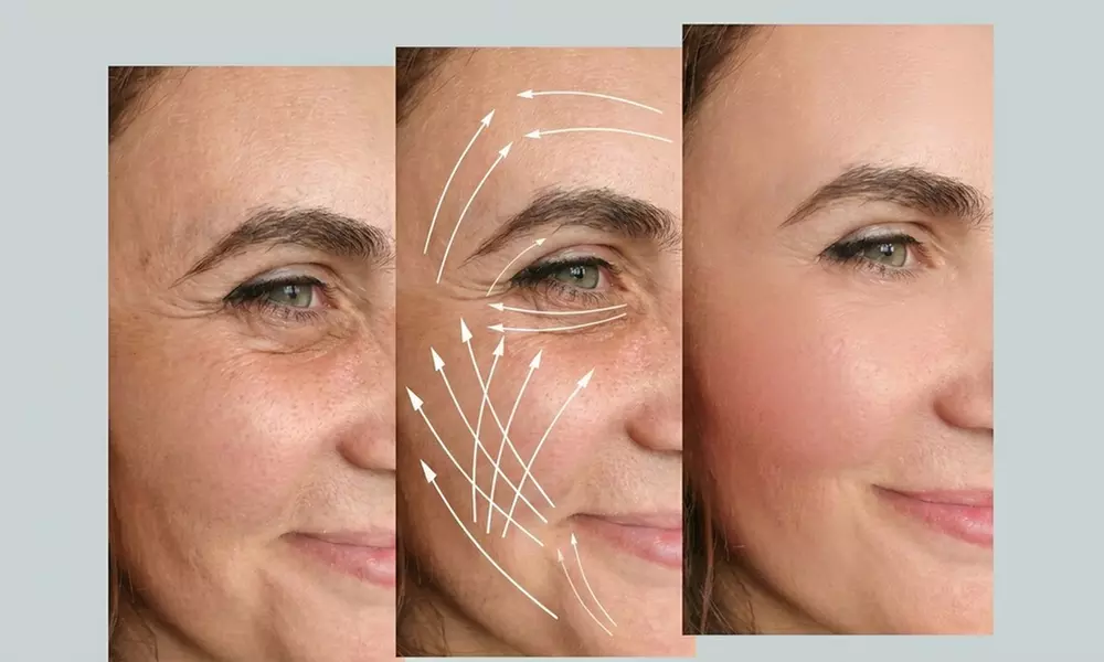 One or Three Micro-Needling Treatments with  PRP Facial