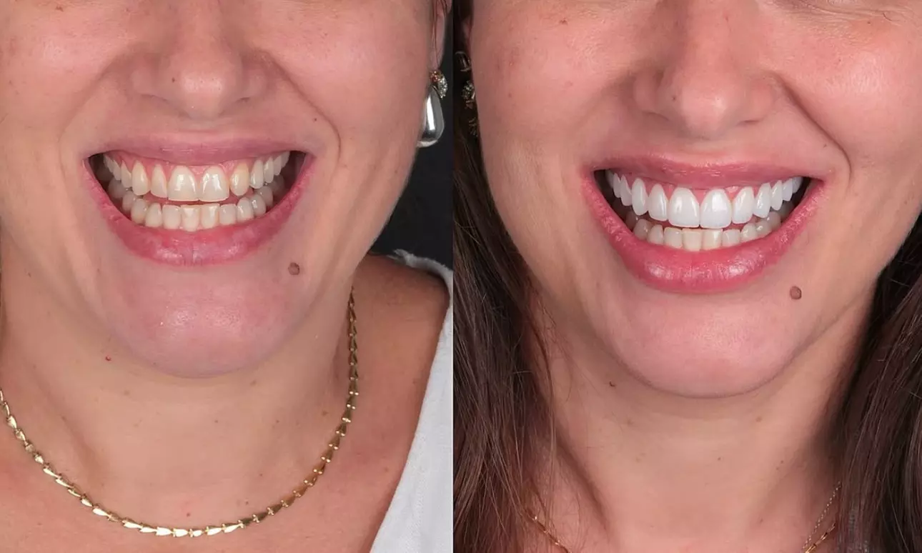 Colocación de hasta 4 carillas dentales de composite o cerámica