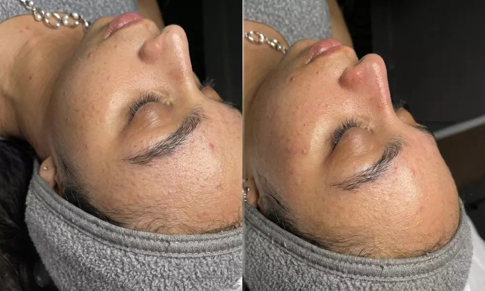 ZF Studio  Aesthetic: Polynucleotides Eye Treatment or Profhilo® Skin Booster 5 Point Face Lift(Up to 43% Off) - Second Medium