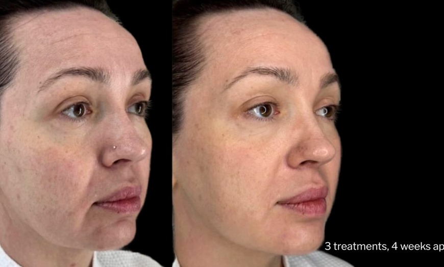 Image 4: Morpheus8 Non-surgical Tightening - Allure Passions Aesthetic Clinic