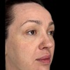 Image 4: Morpheus8 Non-surgical Tightening - Allure Passions Aesthetic Clinic