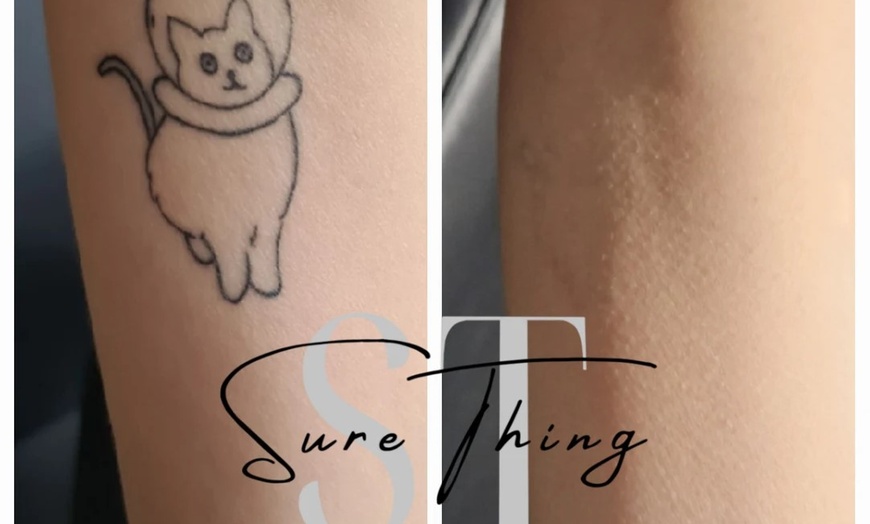 Image 7: Up to 86% Off on Tattoo Removal at Sure Thing Studio