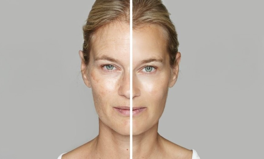 Image 3: Lumecca IPL Session for Full Face, Face and Neck or Face, Neck & Chest