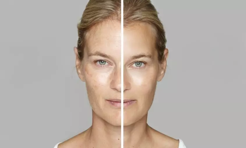 Lumecca IPL Session for Full Face, Face and Neck or Face, Neck & Chest