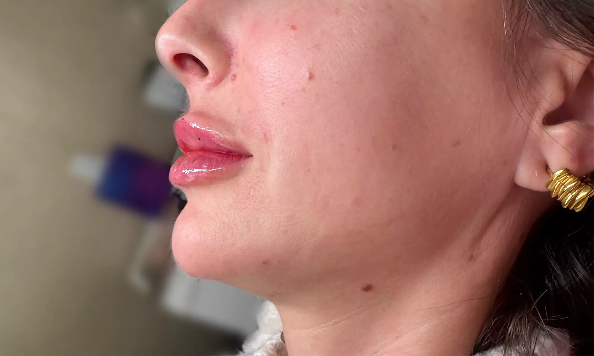 Enhance Your Natural Beauty with Dermal Filler Treatments