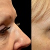 Image 7: Morpheus8 Non-surgical Tightening - Allure Passions Aesthetic Clinic