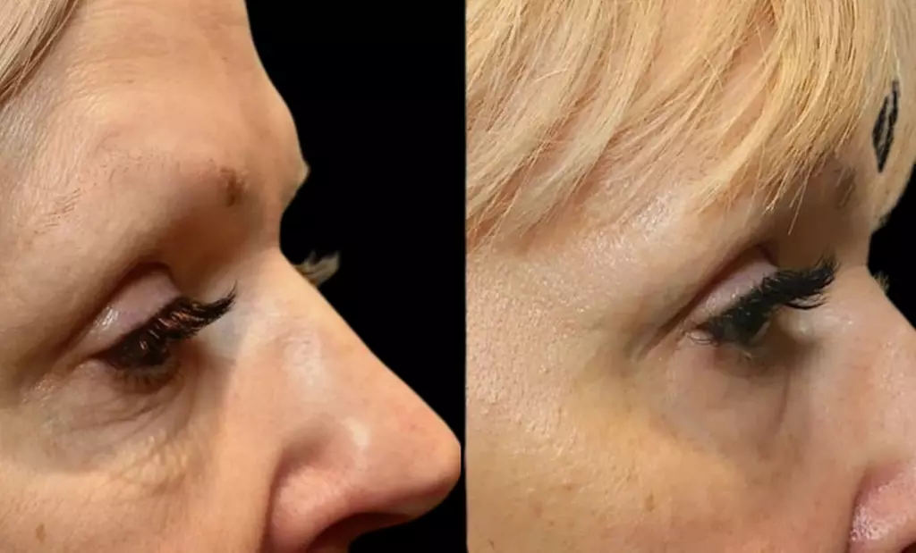 Morpheus8 Non-surgical Tightening - Allure Passions Aesthetic Clinic