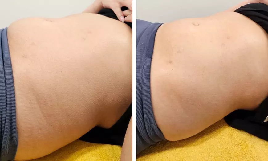 Image 2: Enjoy Pressotherapy Lymphatic Massage, RF Tightening, or Cavitation!