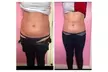 One, Two, or Three Fat Freezing Treatments with Complimentary Meal Plan at Liposuction Belfast (Up to 67% Off) - Image 2