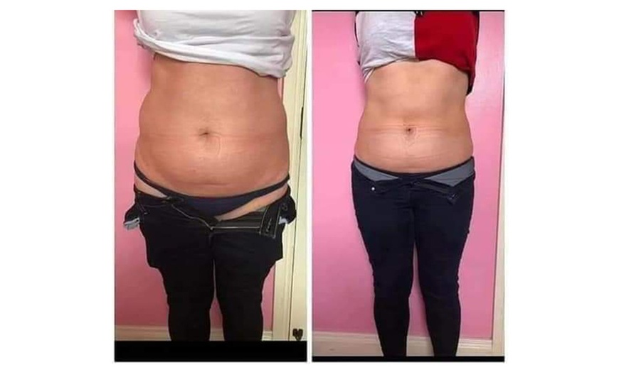 Image 2: Fat Freezing with Complimentary Meal Plan at Liposuction Belfast