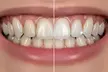 Professional 1-Hour Teeth Whitening Session at Advanced Smile (save up to 67%) - Second Medium