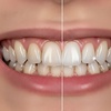 Image 2: Professional 1-Hour Teeth Whitening Session at Advanced Smile (save up to 67%)