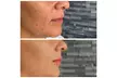 IPL Sessions for Face or Face & Neck to Rejuvenate Skin at Phoenix Laser And Rejuvenation Center (Up To 78% Off) - Second Medium