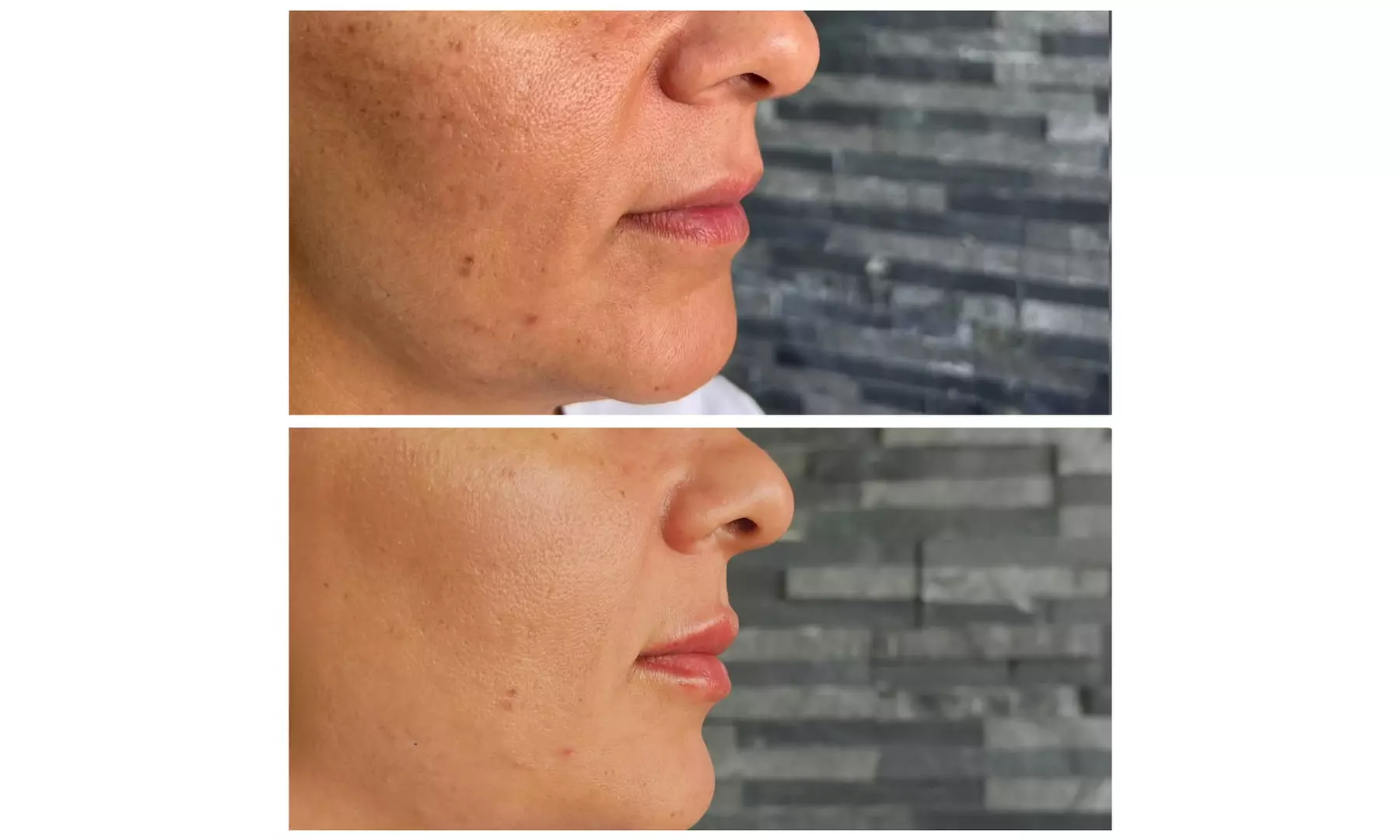 IPL Sessions for Face or Face & Neck