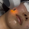 Image 4: Get Smooth Skin with IPL Lumecca Photo Facial Options