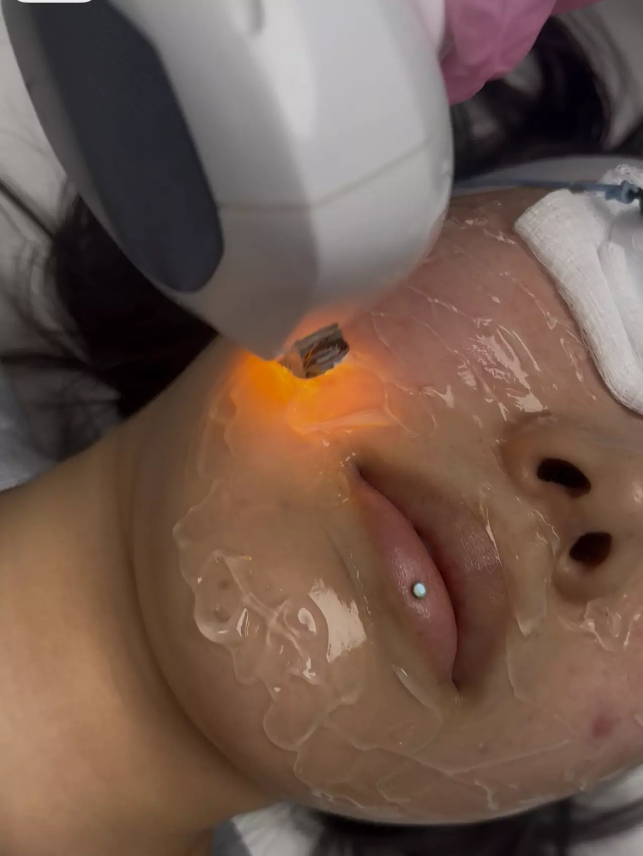 Get Smooth Skin with IPL Lumecca Photo Facial Options