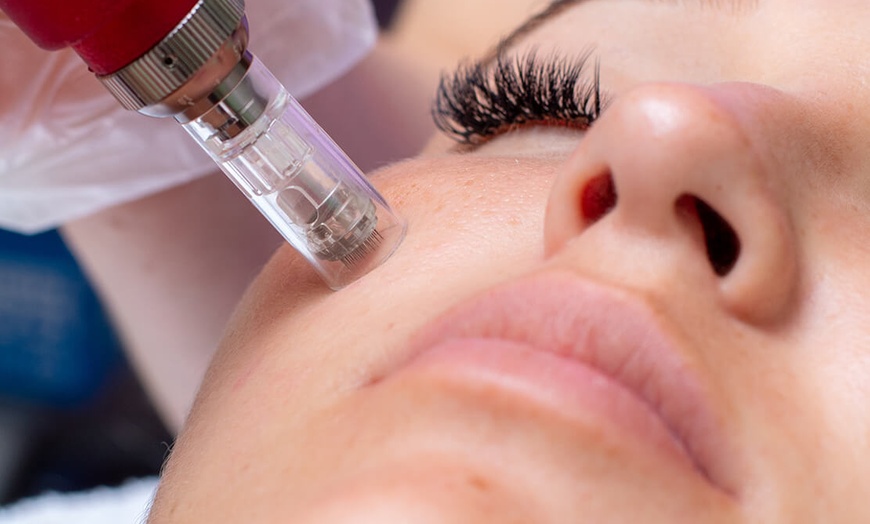 Image 1: Experience Glowing Skin with 1,2 or 4 PRP Facial with Micro-Needling