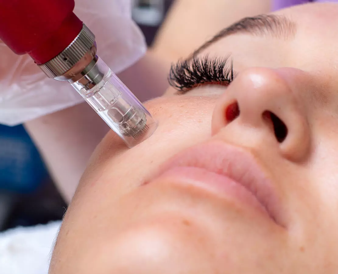 Experience Glowing Skin with 1,2 or 4 PRP Facial Treatments with Micro-Needling at Jeune MedSpa Up To 73%  - Primary Image
